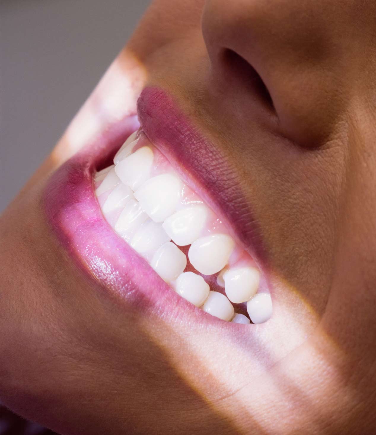 dientes-blancos-donostia-amadent