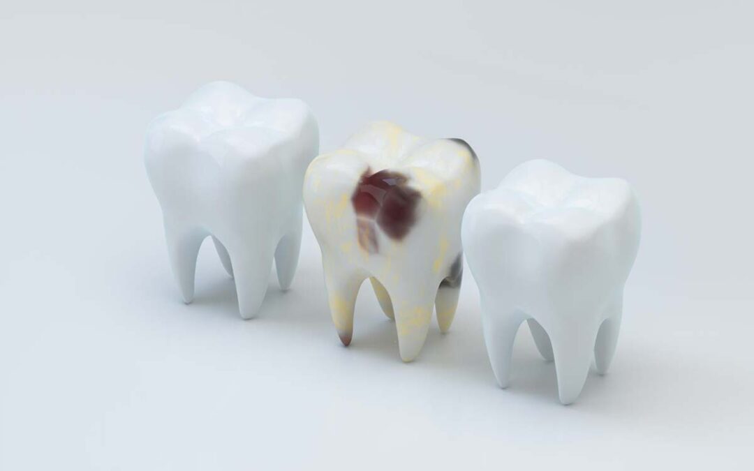 Caries, como tratarlas y como evitarlas.