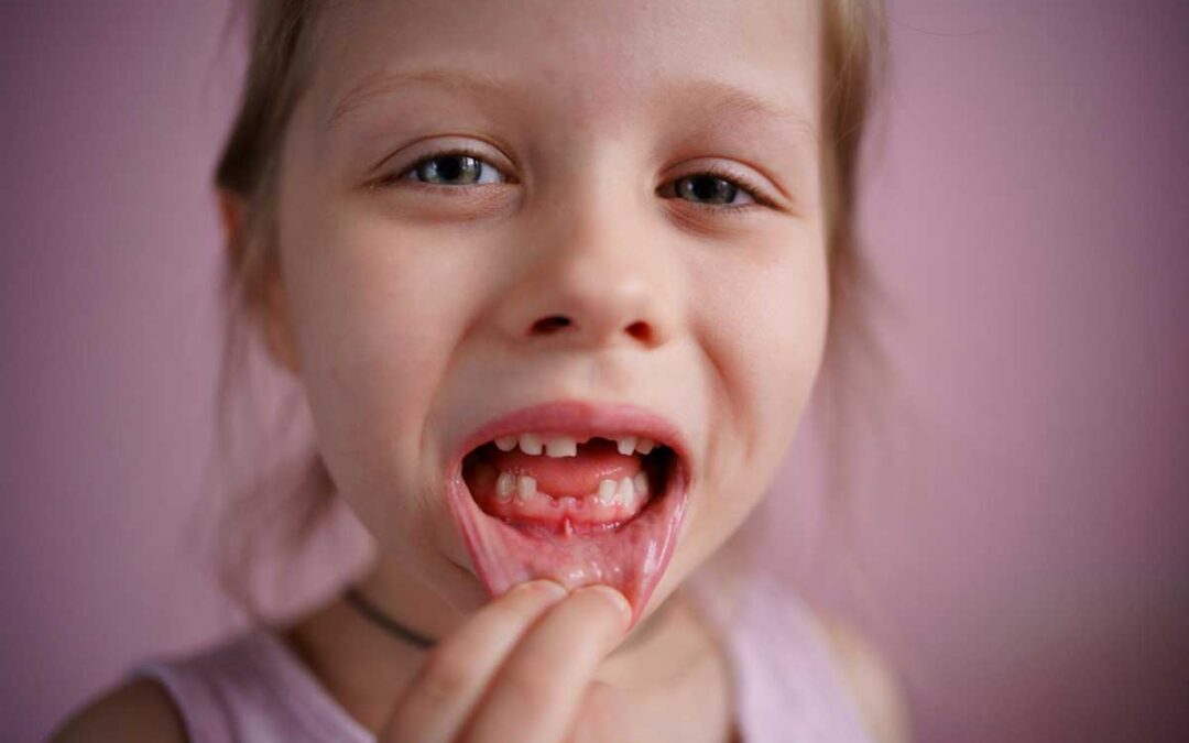 Causas y prevención de las caries en niños