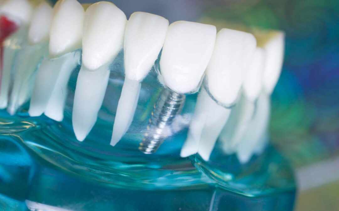 ¿Cuánto cuesta un implante dental en Donostia?