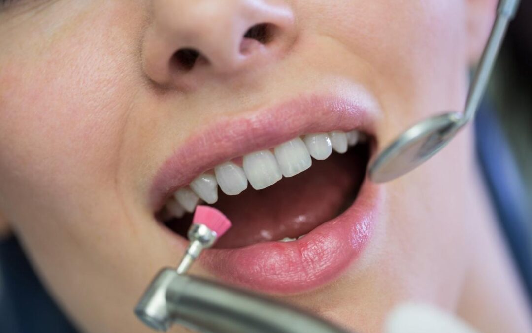 Limpieza dental en Donostia: qué incluye, cuánto dura y cada cuánto hay que hacerla