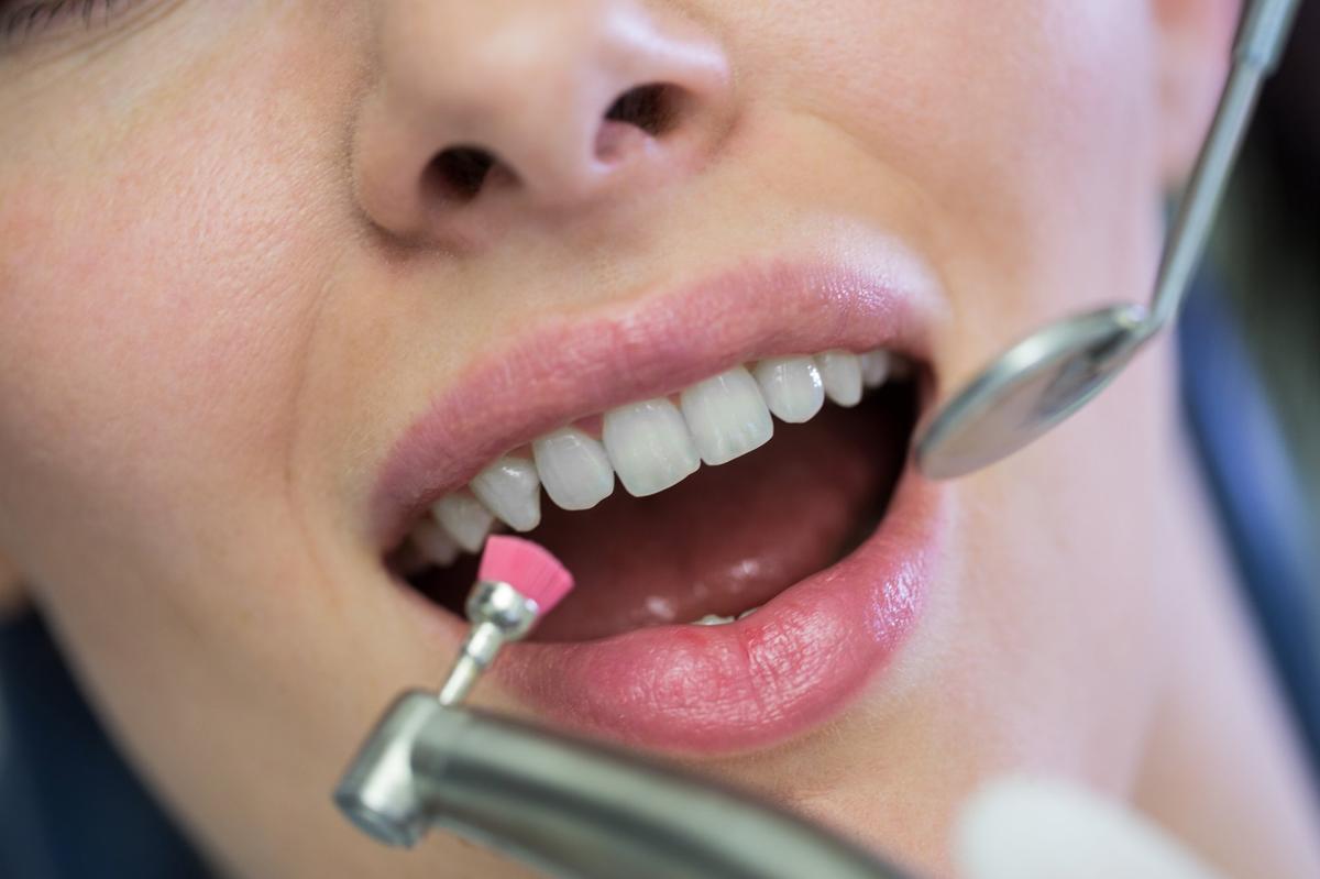 Higienista dental realizando limpieza dental profesional en clínica Amadent Donostia