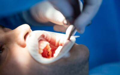 Enfermedad de las encías en Donostia: síntomas, riesgos y tratamiento periodontal