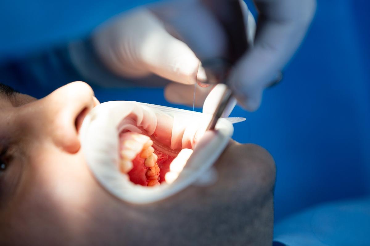 Tratamiento periodontal de encías en clínica dental Amadent Donostia